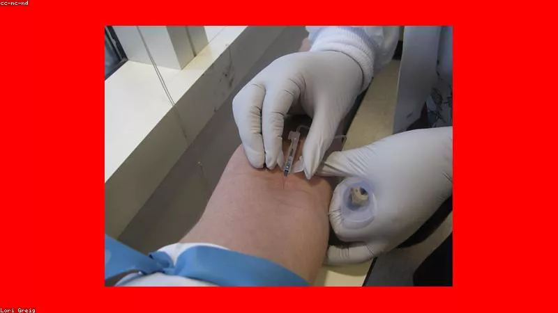 Phân tích y khoa hình ảnh Tương tác của Prazosin với rượu bia và chất kích thích